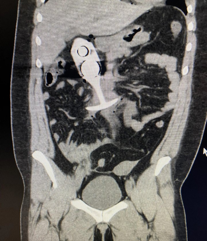 butt plug mri